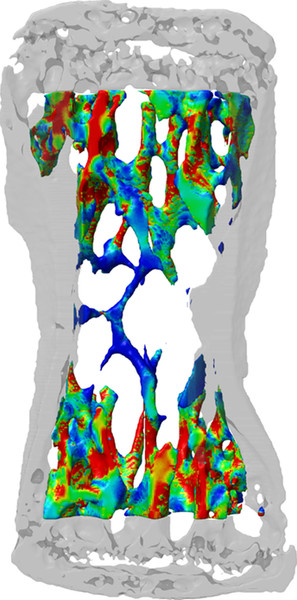 Here, the 3D simulation depicts the stress on the bone tissue, calculated on the basis of CT images. The red areas represent high mechanical stress and bone formation while the blue ones represent low stress and bone resorption.